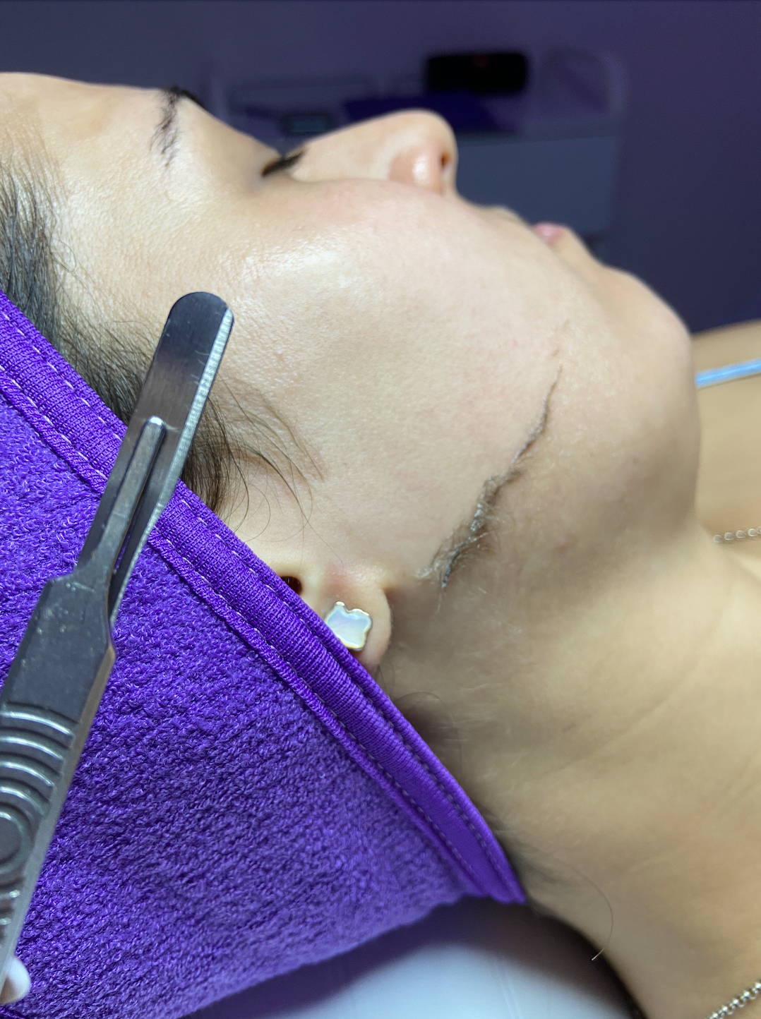 Dermaplane + PEEL